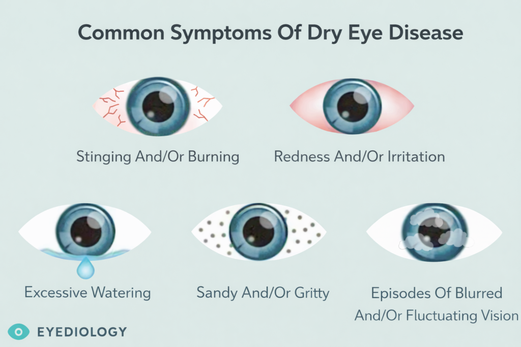 Infographic illustrating common symptoms of dry eye disease including stinging, burning, redness, watering, gritty sensation, and blurred or fluctuating vision.